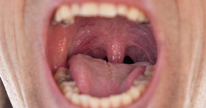 Epiglotun uzaması: nedenleri, belirtileri ve tedavi yöntemleri