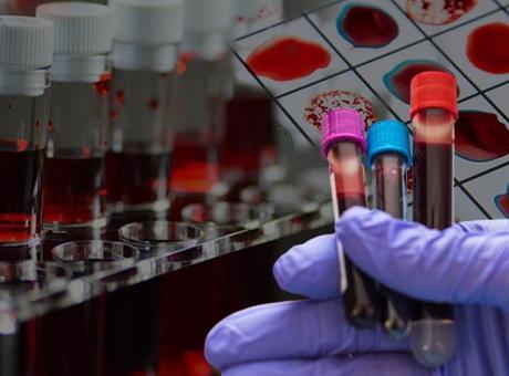 Dünyada Sadece 50 Kişide Bulunan ‘Altın Kan’, Laboratuvar Ortamında Üretilebilir Mi?